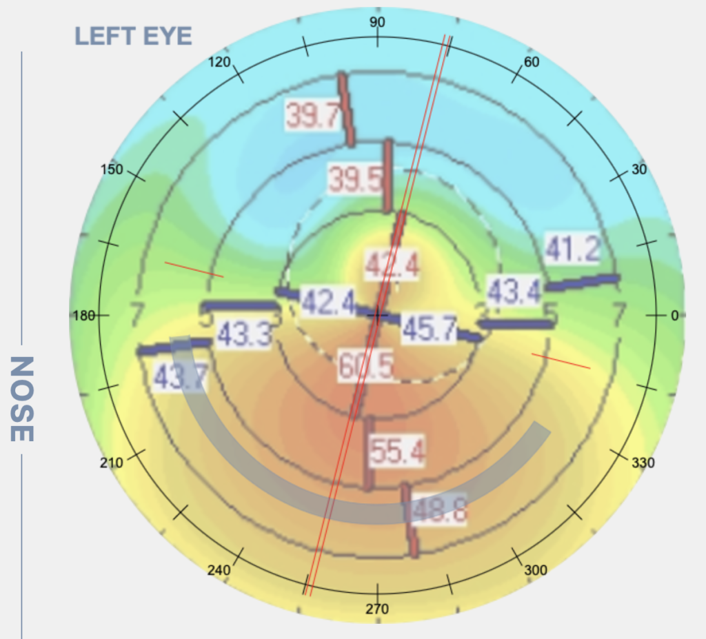 CAIRS corneal topography
